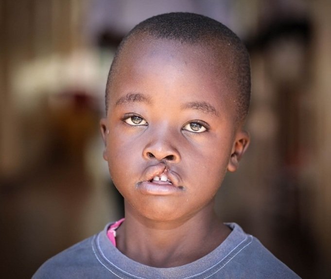 Read more about the article Increasing access to treatment for cleft victims in Nigeria