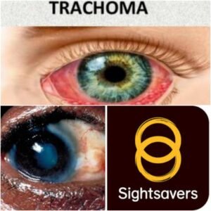 Nigeria, 15 other countries get $36.5m to eliminate trachoma