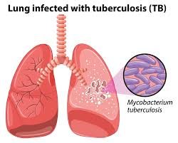 Read more about the article TB: Foundation screens 760 persons
