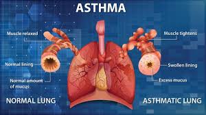 Asthma care: Upholding the right to breath