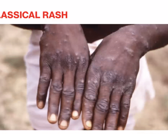 Adewole urges urgent national effort to tackle Mpox disease Adewole urges urgent national effort to tackle Mpox disease