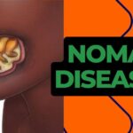 MSF offers free life-changing facial surgeries for 1,074 indigent Noma survivors MSF offers free life-changing facial surgeries for 1,074 indigent Noma survivors