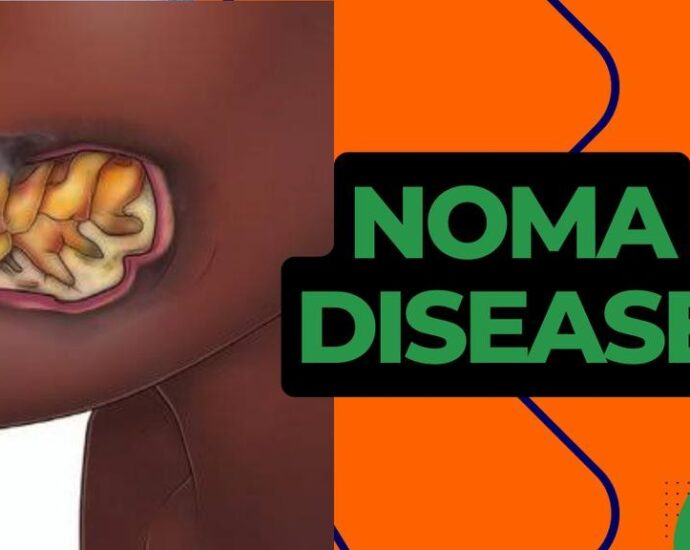 MSF offers free life-changing facial surgeries for 1,074 indigent Noma survivors