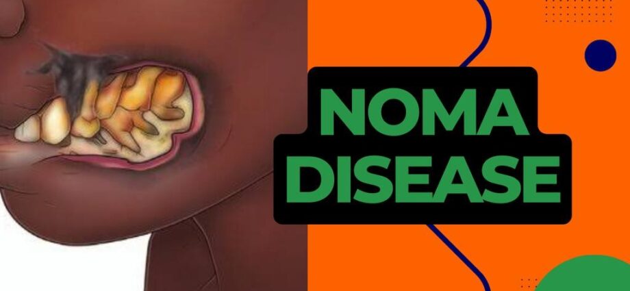 MSF offers free life-changing facial surgeries for 1,074 indigent Noma survivors MSF offers free life-changing facial surgeries for 1,074 indigent Noma survivors