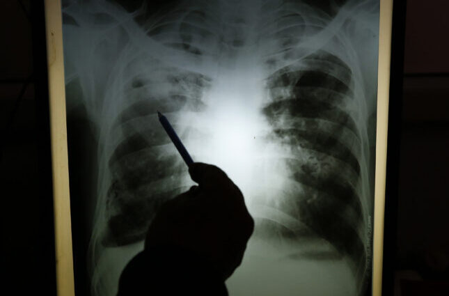 Experts say stigma worsening Nigeria’s TB burden