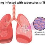 TB cases fall for first time since 2020 – WHO TB cases fall for first time since 2020 – WHO
