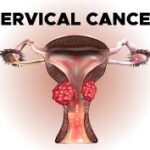 Rwanda reports progress in cervical cancer elimination