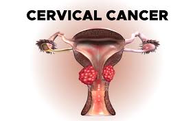 Rwanda reports progress in cervical cancer elimination