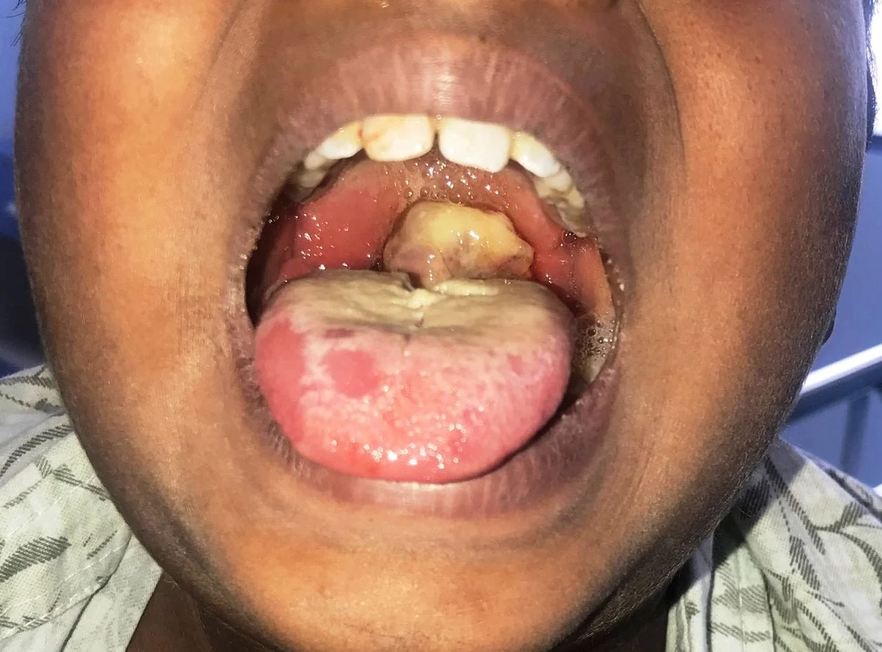 Diphtheria: 93% of cases had no full vaccination –NPHCDA